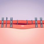 Bariatric Surgical Stapling And Immune Function